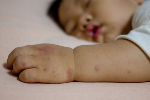 Hand, foot and mouth disease :: Hertfordshire and West Essex Healthier ...