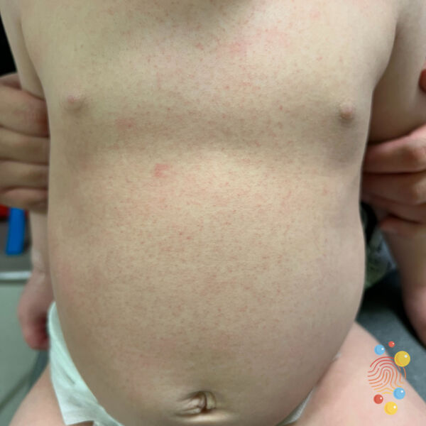 Strep Throat and Scarlet Fever: What's the Connection?