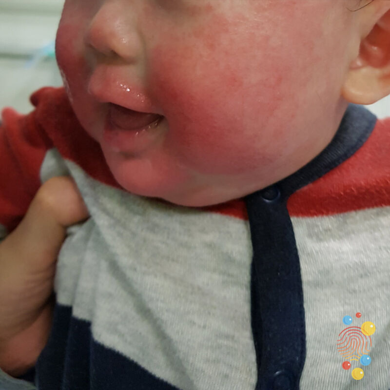 Group A Streptococcus and Scarlet Fever :: Hertfordshire and West Essex  Healthier Together